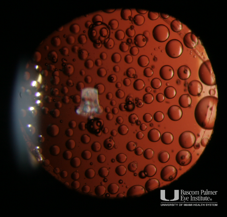 SO071620OI: Silicone Oil Droplets On A Silicone Intraocular Lens